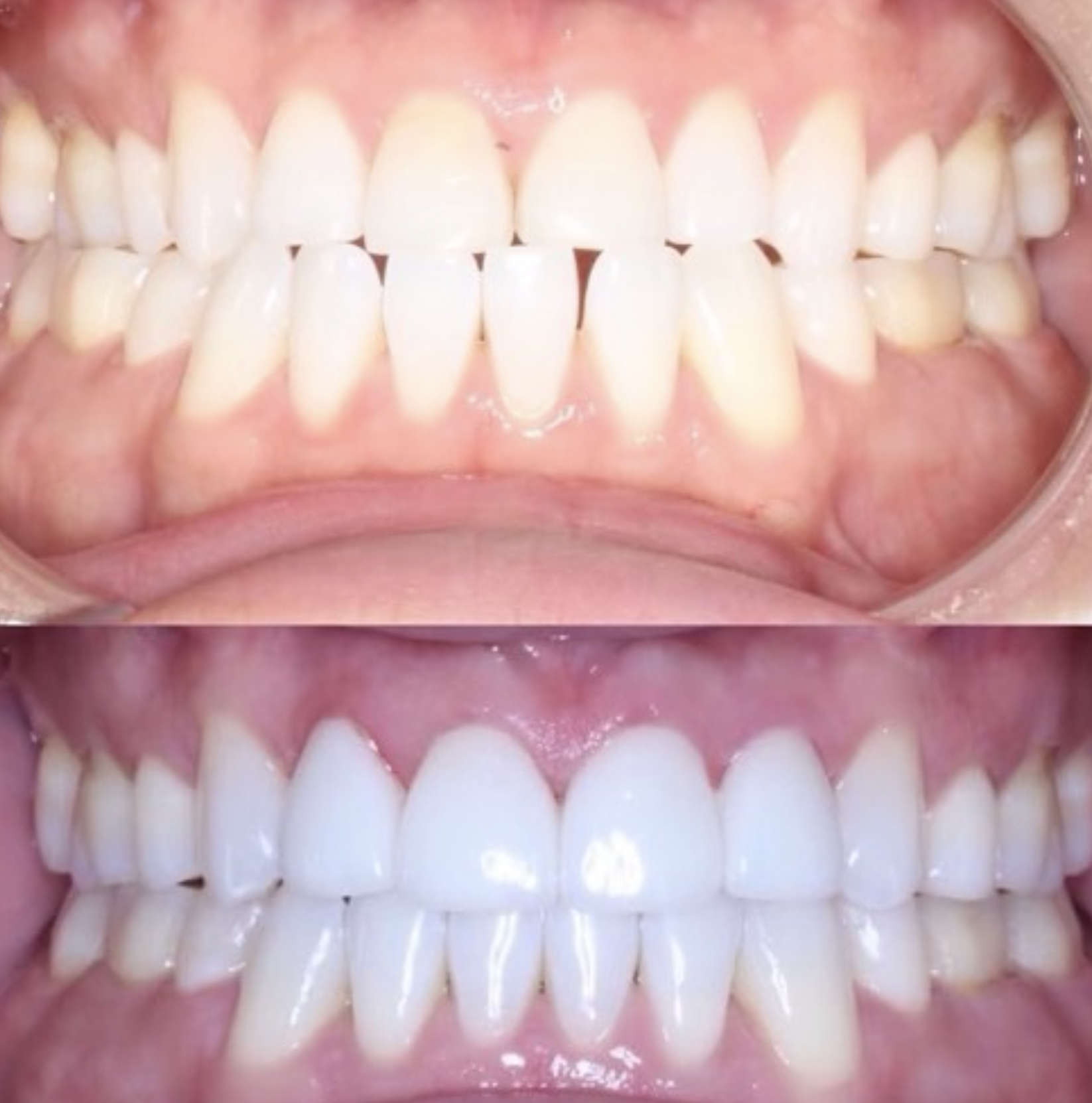 Spacing corrected: patient before treatment above and completed result below