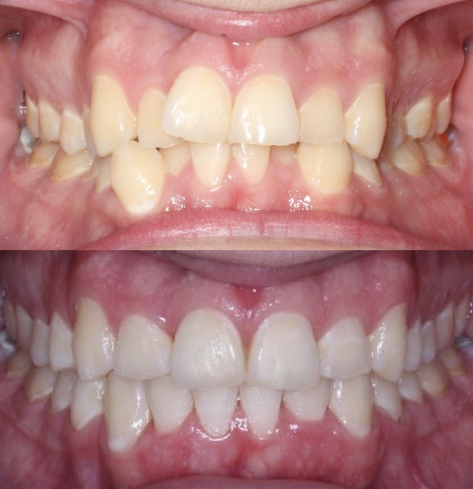 Crowding aligned: patient before treatment above and completed result below