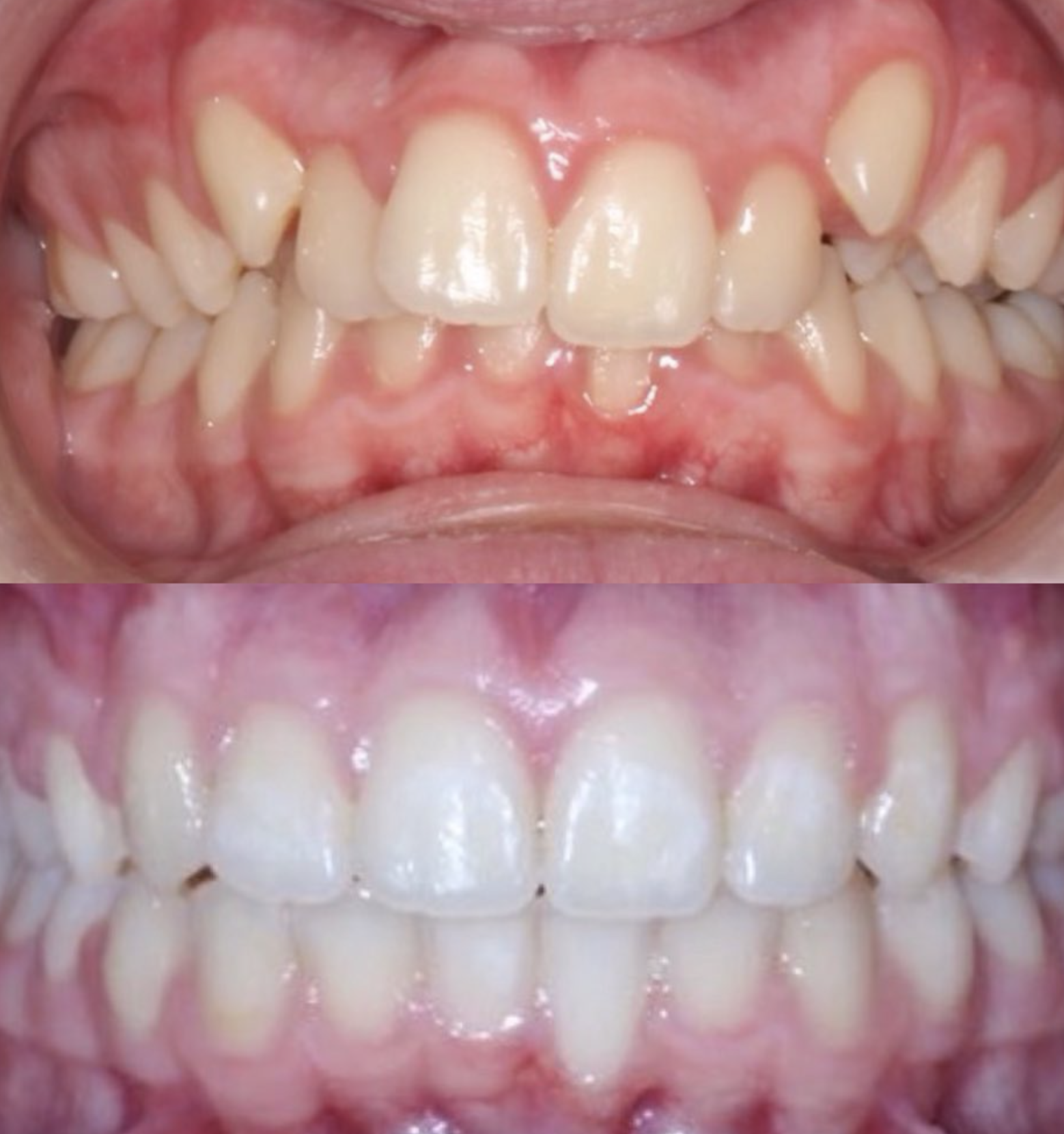Displaced teeth aligned: patient before treatment above and completed result below