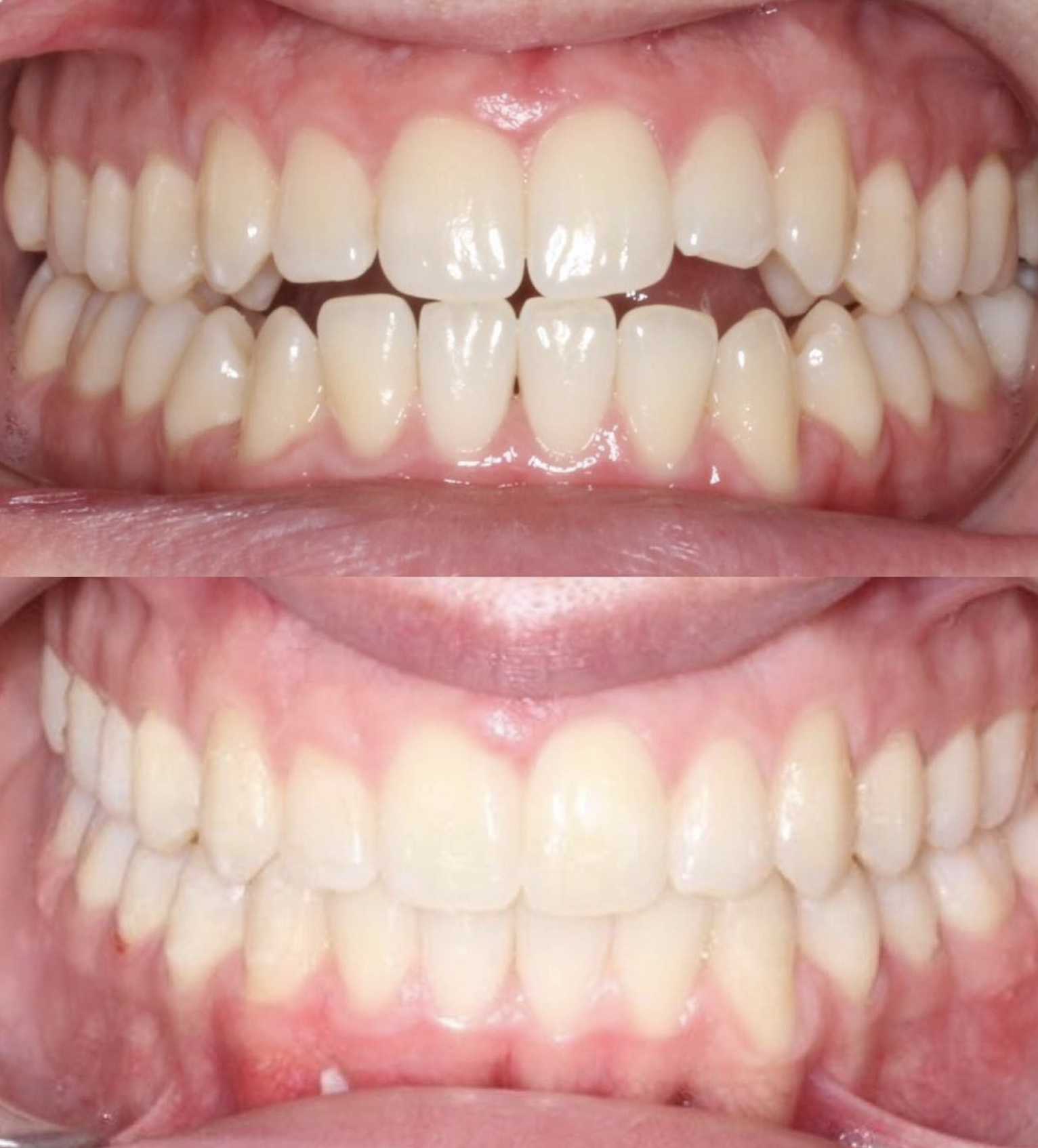 Bite and alignment refined: patient before treatment above and completed result below