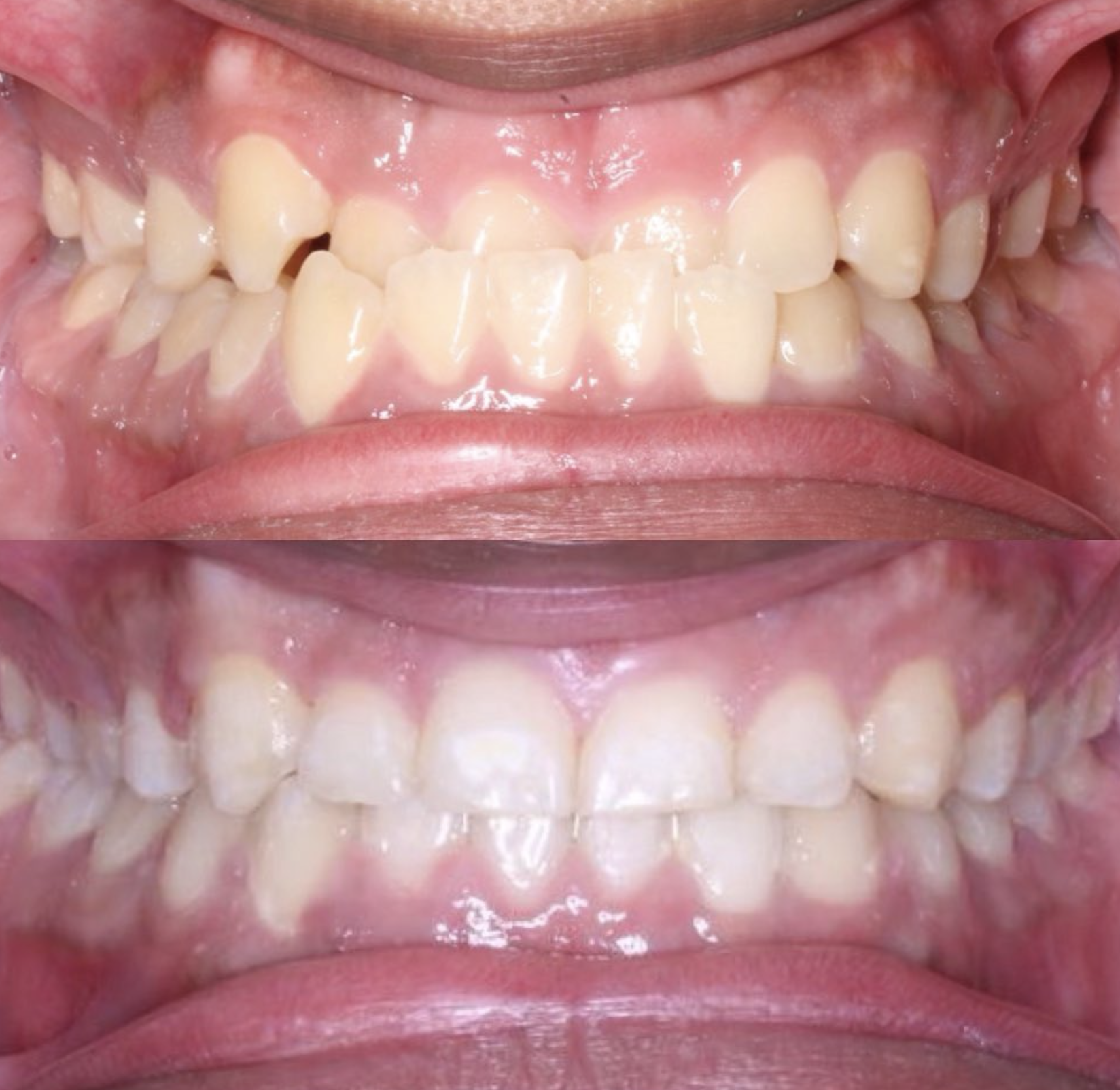 Severe crowding corrected: patient before treatment above and completed result below