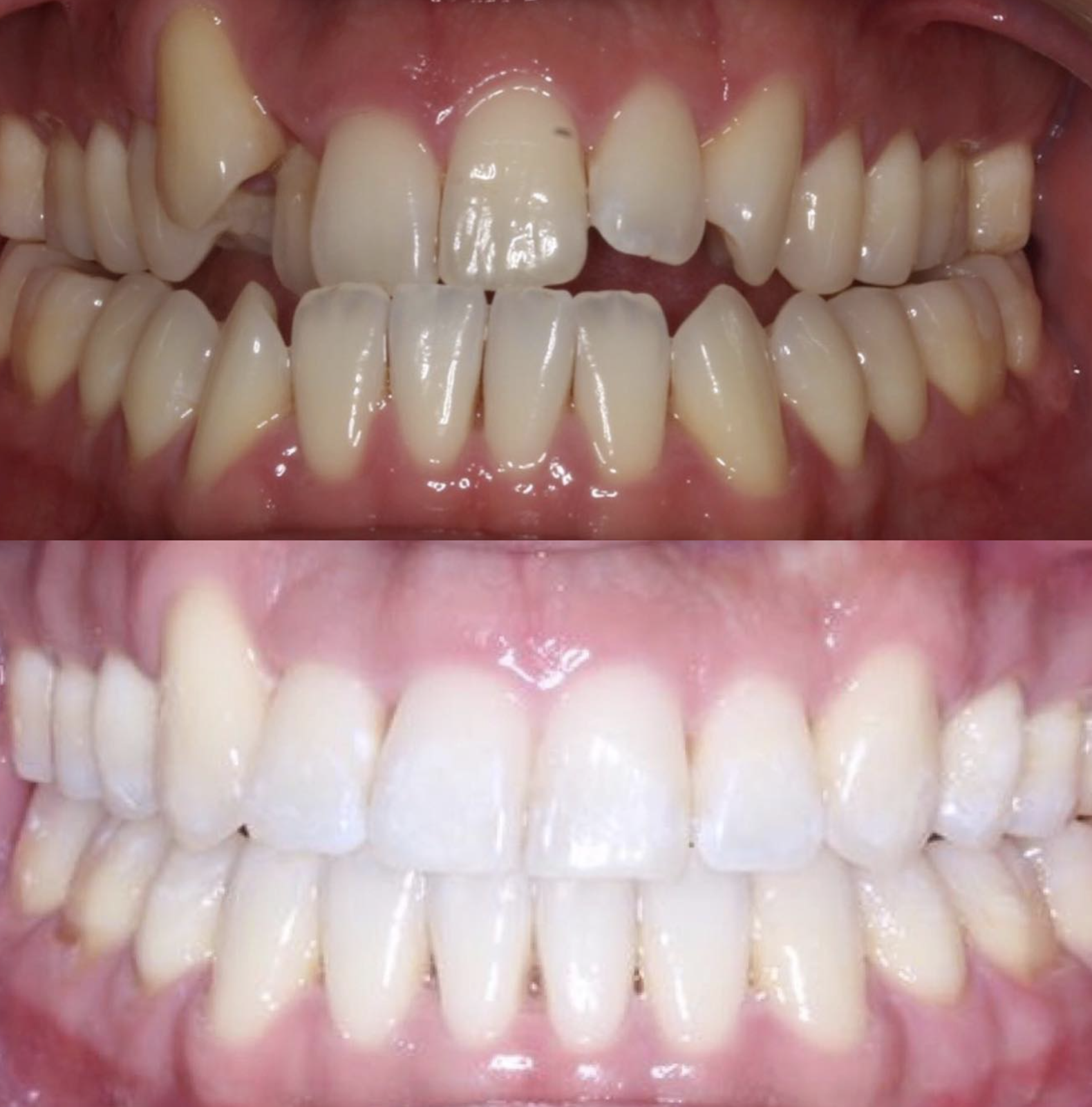 Arch alignment restored: patient before treatment above and completed result below