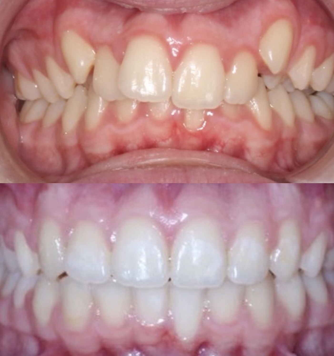 Crowding & bite corrected: patient before treatment above and completed result below